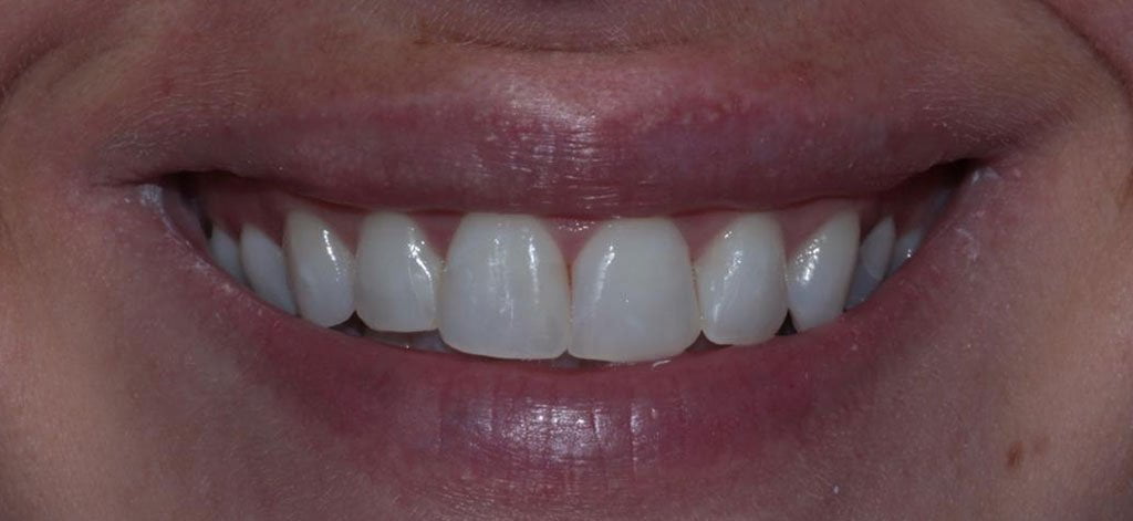 cosmetic bonding after result